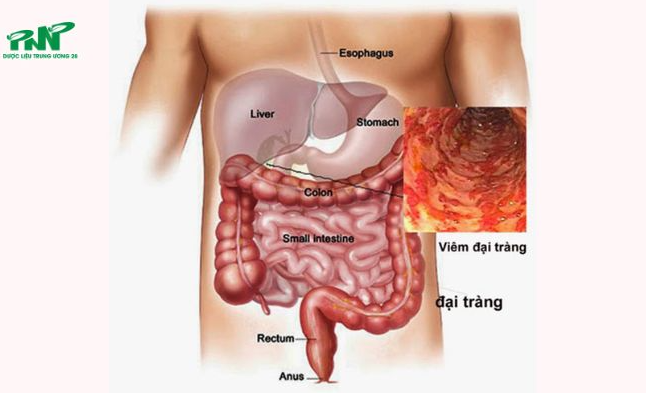 Điều trị vi&ecirc;m đại tr&agrave;ng bằng c&aacute;ch n&agrave;o mang lại hiệu quả cao?