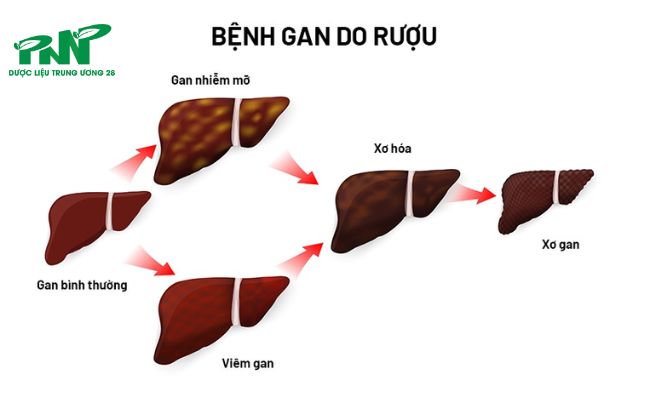 Bệnh gan do rượu