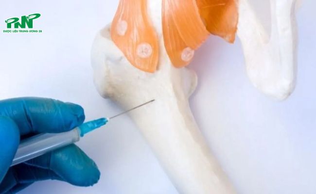 Phẫu thuật nâng xương sống được thực hiện bằng cách tiêm xi măng sinh học vào cột sống bị thiếu hụt