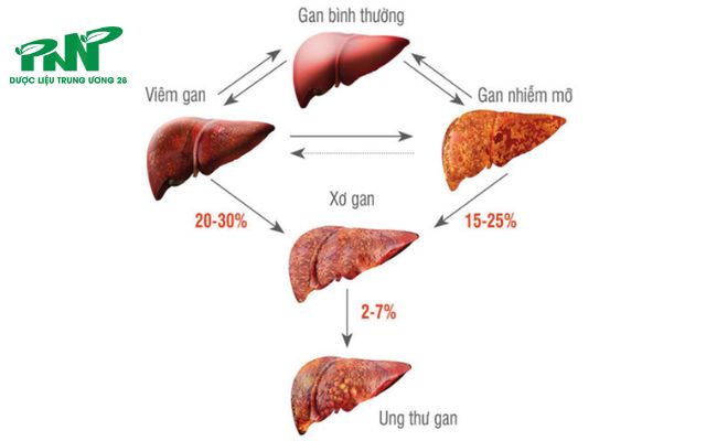 Tiến triển của bệnh gan qua các giai đoạn